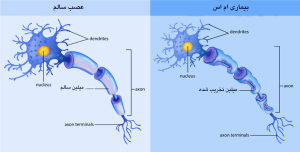 میلین تخریب شده در اثر بیماری MS